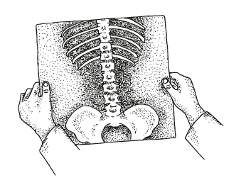 Engraving of two hands holding an x-ray film showing the lumbar spine and pelvis.